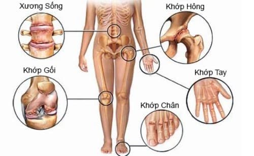 Các vị trí dễ bị thoái hóa khớp. Ảnh: camnanglamdep.