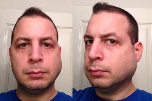 Tuyến nước bọt dưới lưỡi, dưới mang tai hoặc dưới xương hàm bị sưng lên là một trong những dấu hiệu cho thấy tuyến nước bọt có vấn đề.