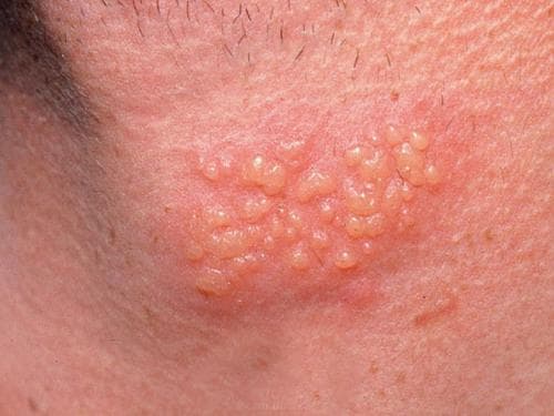 Bệnh mụn rộp là gì? Nguyên nhân triệu chứng và cách điều trị ra sao?