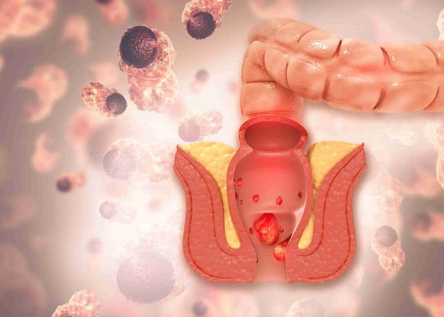 Bệnh trĩ điều trị thế nào? Một số lưu ý sau điều trị