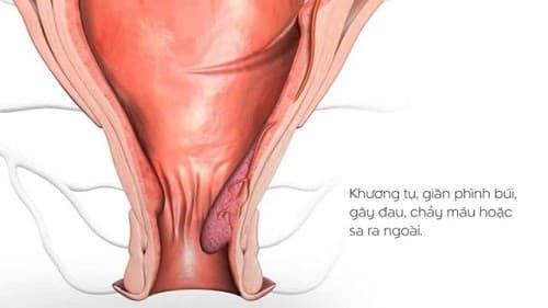 Bệnh trĩ có thể gây ra các biến chứng nguy hiểm như tắc mạch, nghẹt, nhiễm khuẩn...