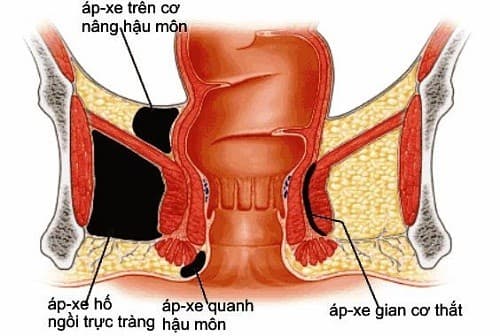 cac-benh-viem-nhiem-vung-hau-mon