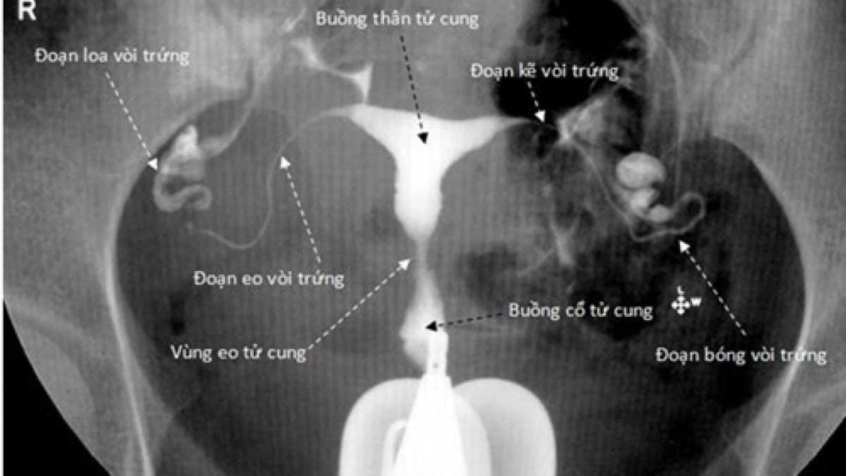 Chụp tử cung vòi trứng và những điều chị em cần biết