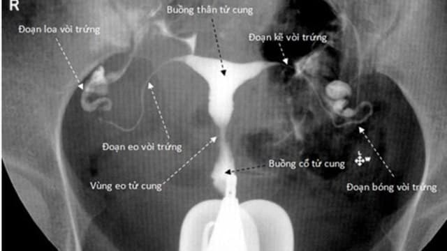 Chụp tử cung vòi trứng và những điều chị em cần biết