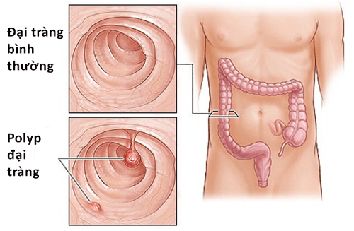 Polyp đại tràng là một tổn thương nhỏ lành tính có hình dạng giống như khối u