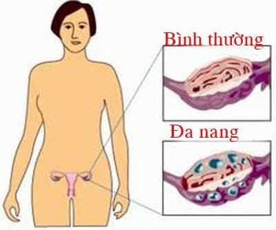 dau-hieu-da-nang-buong-trung