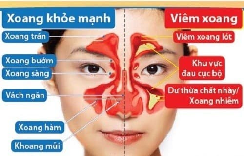 Viêm xoang do nhiều nguyên nhân khác nhau gây bệnh như thay đổi thời tiết, nhiễm khuẩn đường hô hấp