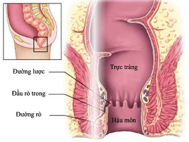 Rò hậu môn ở trẻ em