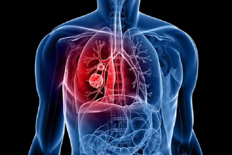 Ung thư phổi di căn tới các bộ phận khác của cơ thể thông qua máu và hệ bạch huyết