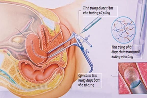 IUI là phương pháp thụ tinh nhân tạo bằng cách đưa một catheter rất nhỏ, mềm, mảnh đi qua cổ tử cung và bơm tinh trùng đã lọc rửa vào buồng tử cung để tăng cơ hội thụ thai