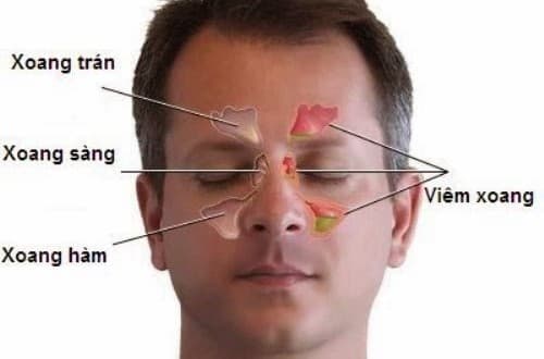 luu-y-sau-khi-mo-viem-xoang