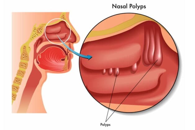 Polyp mũi là hậu quả của các phản ứng viêm tiếp diễn liên tục tại niêm mạc mũi.