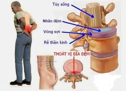 Triệu chứng bệnh thoát vị đĩa đệm