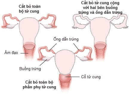 Phẫu thuật cắt bỏ tử cung là phương pháp phẫu thuật trong đó một phần hoặc toàn bộ tử cung sẽ bị loại bỏ.