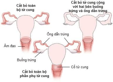 Phẫu thuật cắt bỏ tử cung sẽ bị loại bỏ tử cung