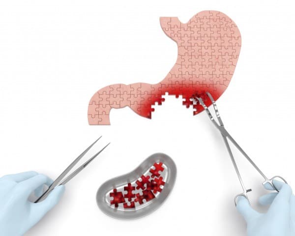 Phẫu thuật cắt dạ dày được sử dụng để điều trị các vấn đề về dạ dày khi các phương pháp khác không có hiệu quả.