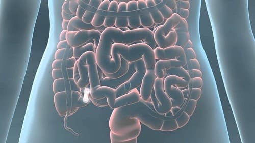 Tắc ruột là một hội chứng do việc ngừng lưu thông của hơi và dịch tiêu hoá trong lòng ruột gây ra. 