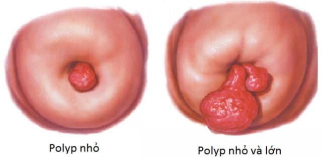 Polyp cổ tử cung là gì? Điều trĩ có dứt điểm được không?