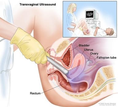 Siêu âm buồng trứng đa nang phát hiện và loại bỏ