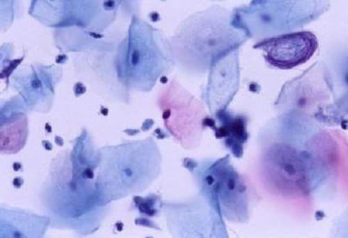 Soi tươi dịch âm đạo giúp chẩn đoán chính xác nguyên nhân gây ra các bệnh ở vùng kín