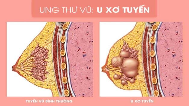 Các khối u vú có thể là dạng nang (u nang vú) hoặc dạng sợi (u sợi/u xơ vú)