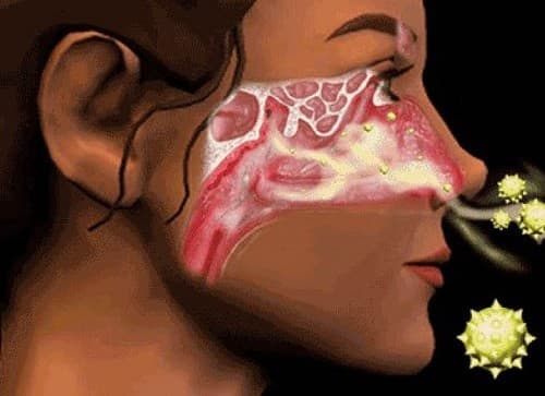 Bệnh do nhiều nguyên nhân gây ra như nhiễm virut, vi khuẩn