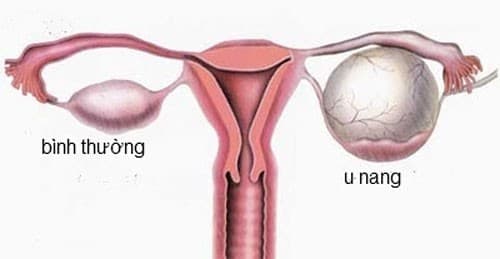 U nang buồng trứng là bệnh lành tính nhưng có thể gây biến chứng