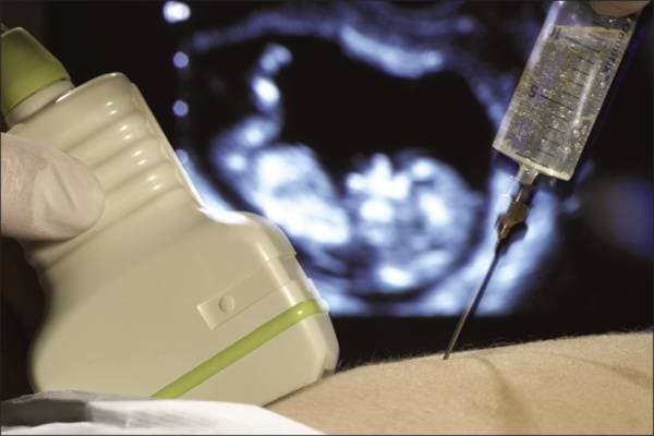 Chọc ối xét nghiệm có đau không là quan tâm của nhiều thai phụ.