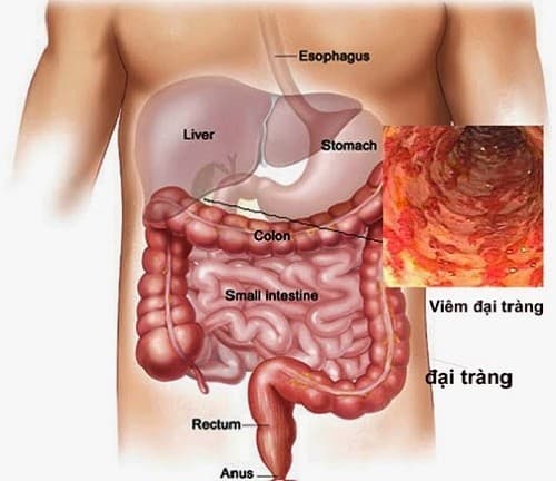 Bệnh ở đại tràng lành tính thường có thể điều trị hiệu quả bằng thuốc hoặc phẫu thuật
