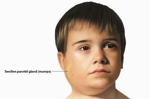 Quai bị là bệnh thường gặp và gây nguy hiểm nếu không điều trị sớm