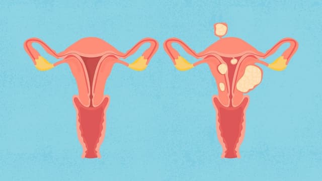 Dấu hiệu nhận biết bệnh u xơ tử cung