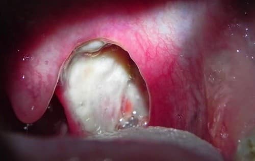 dieu-tri-amidan-hoc-mu-nhu-the-nao