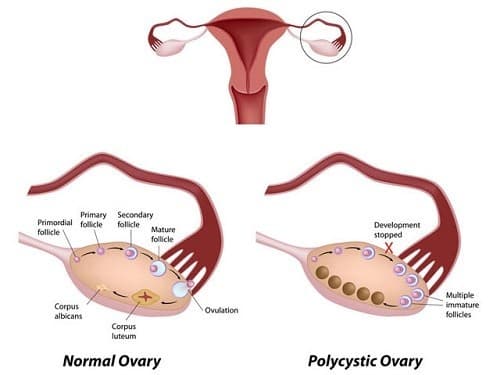 Đa nang buồng trứng là căn bệnh xảy ra khi buồng trứng có nhiều nang nhỏ