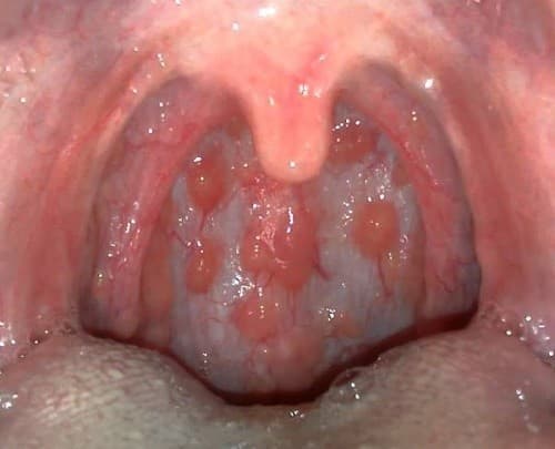 Viêm họng mạn tính được chia thành 4 thể bệnh khác nhau với những biểu hiện riêng, ảnh hưởng tới sức khỏe