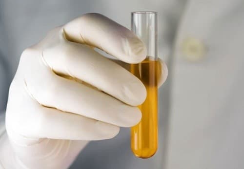 Nếu màu sắc nước tiểu có chiều hướng đậm đặc và tối màu thì có thể bạn đang mắc chứng nhiễm trùng hoặc một số vấn đề khác về sức khỏe.