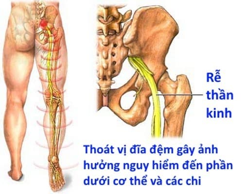 Đau rễ thần kinh cũng là một hậu quả do thoát vị đĩa đệm gây ra