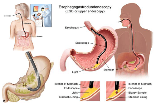 Khi nào cần nội soi đại tràng?