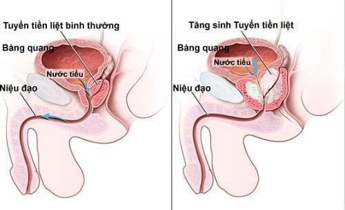 U xơ tuyến tiền liệt là bệnh lý thường gặp gây ảnh hưởng xấu tới sức khỏe, đời sống sinh hoạt tình dục