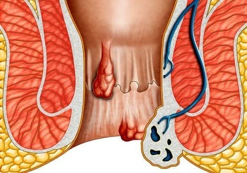Thói quen đứng, đi hoặc nhịn đại tiện lâu ngày sẽ gây bệnh trĩ