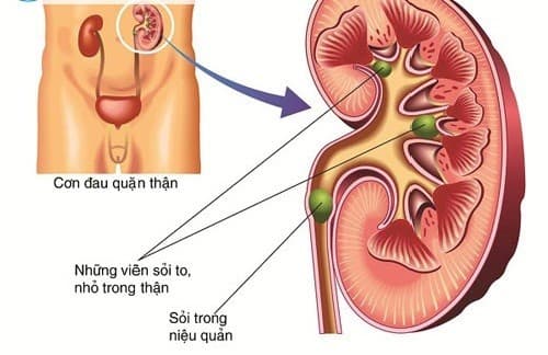 Sỏi thận, viêm đường tiết niệu...cũng là những nguyên nhân gây tiểu ra máu