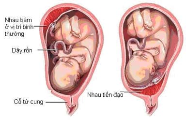 Nhau tiền đạo có nguy hiểm không?