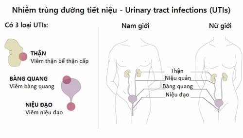 Nhiễm trùng tiết niệu thường gây ảnh hưởng tới sức khỏe, sinh hoạt của người bệnh