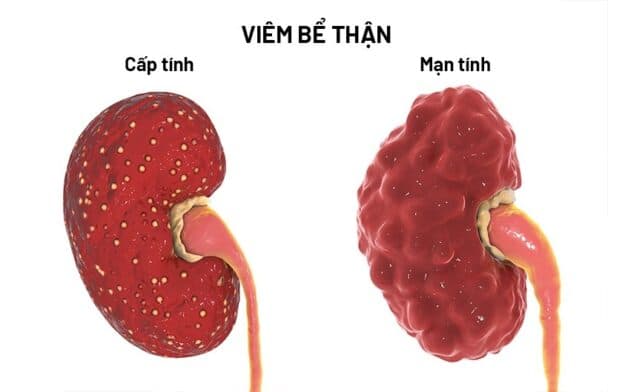 Các triệu chứng viêm đường tiết niệu của nam giới