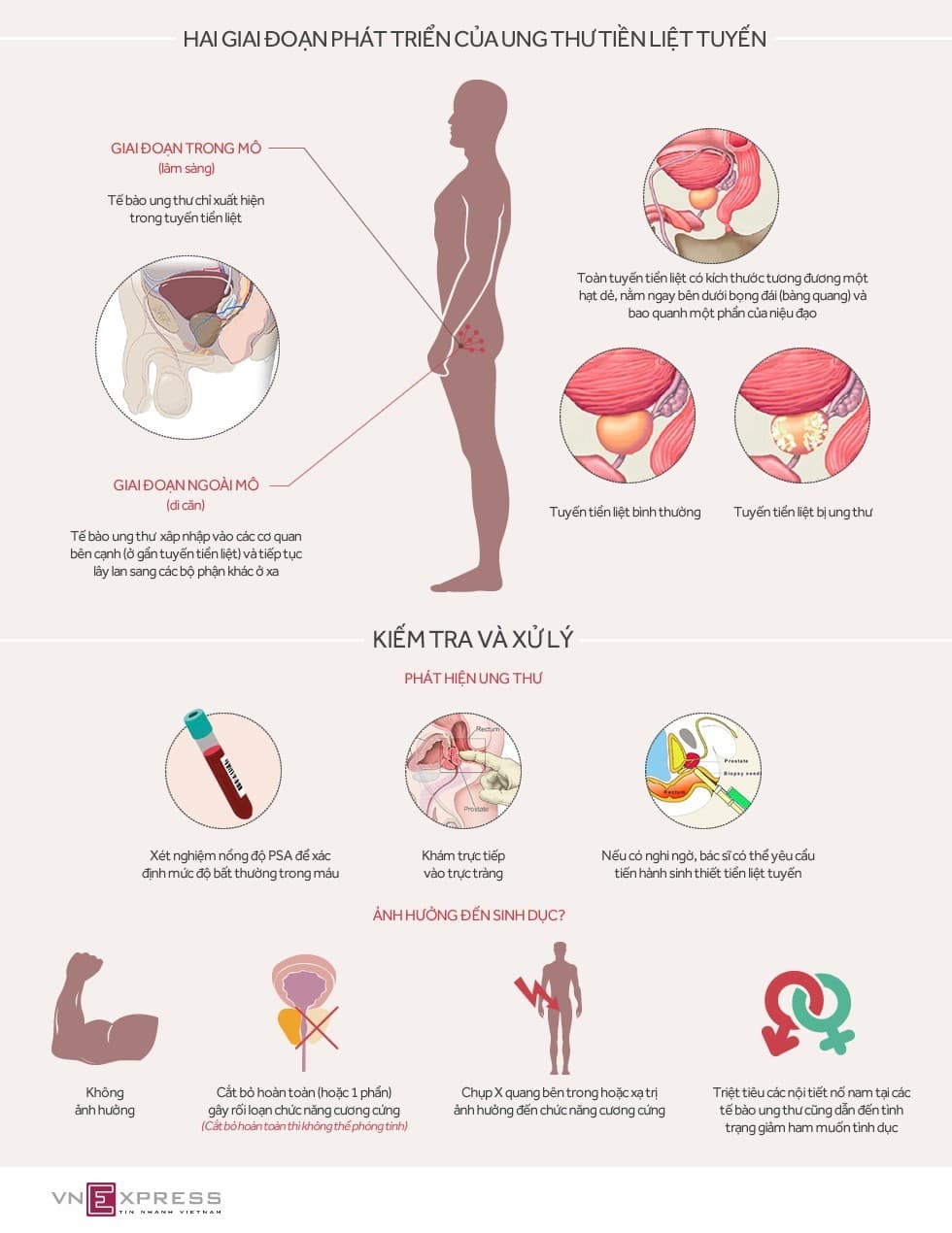 Ung thư tiền liệt tuyến ảnh hưởng ra sao đến sinh dục nam?