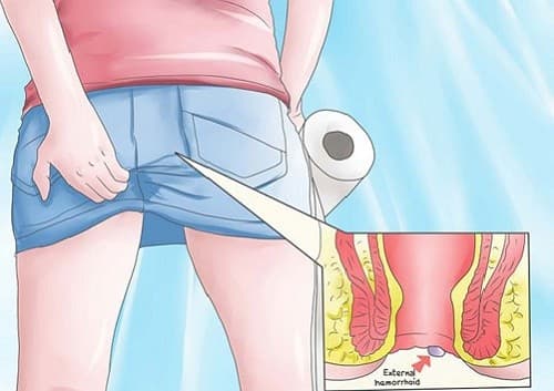 Tình trạng đau hậu môn do nhiều căn bệnh khác nhau khiến người bệnh vô cùng khó chịu