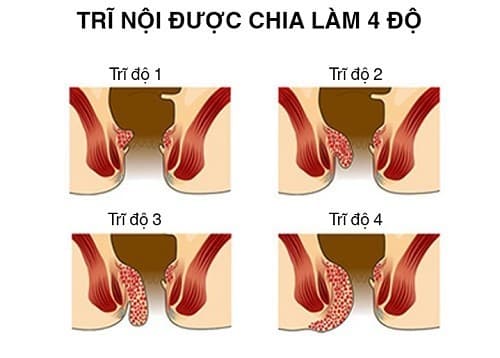 Cách điều trị bệnh trĩ độ 3: Chữa trị như thế nào để đạt hiệu quả?