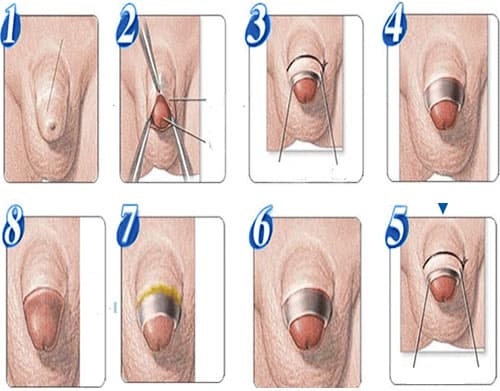 Cắt bao quy đầu ở trẻ em là một thủ thuật giúp loại bỏ phần da bao quy đầu dài và hẹp, không tự tụt xuống