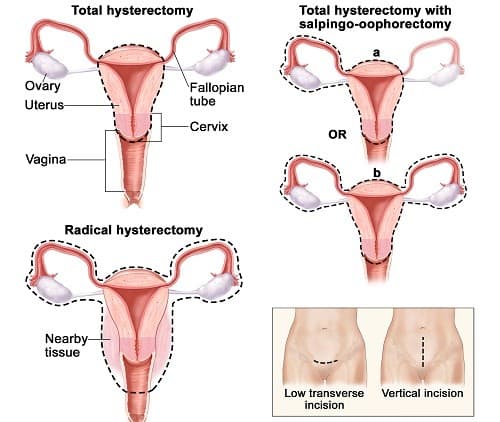 Cắt bỏ tử cung do nhiều lý do nhưng đều có sự chỉ định cụ thể của bác sĩ