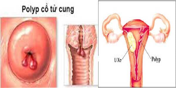 Đa số các polyp là lành tính, không gây triệu chứng, thường phát hiện tình cờ qua các đợt khám phụ khoa.