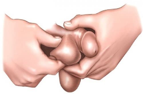 Khi bị bệnh, vùng phía trên tinh hoàn xuất hiện một khối chứa những búi giãn ngoằn ngoèo có thể tự sờ thấy hoặc qua đi khám bác sĩ